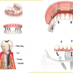 Mất răng đã 8 năm có thể trồng răng được không?