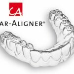 Niềng răng Clear Aligner và niềng răng Invisalign có gì khác biệt?